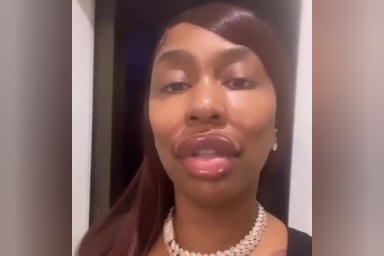 Exhibiting Her Lip Fillers: Kashdoll, Your Opinions on This, Please?