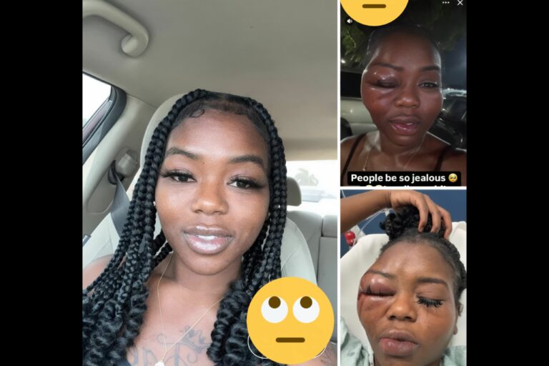 A Young Lady Took to Social Media to Show Her Swollen Eye, Which She Cannot Open, After Being Attacked by a Couple